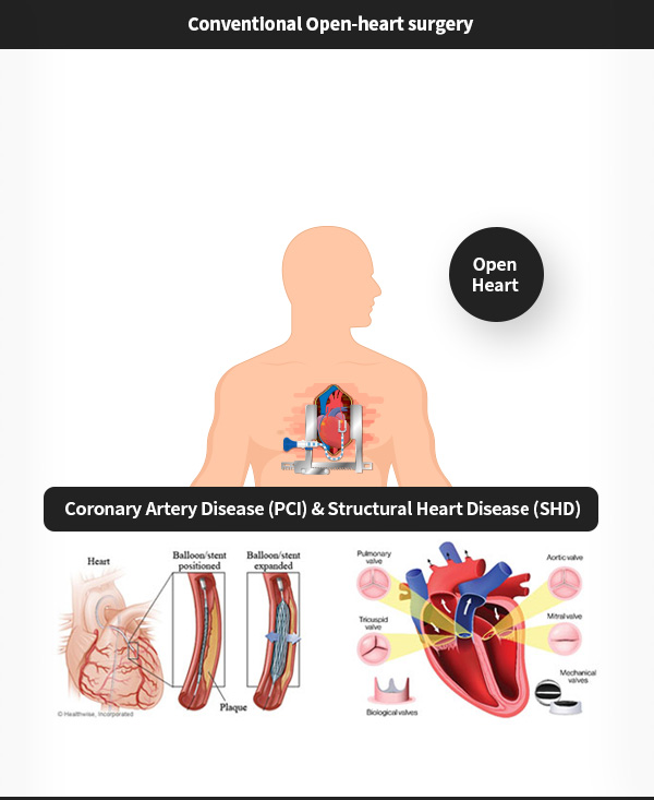 기존의 개흉 수술 방식